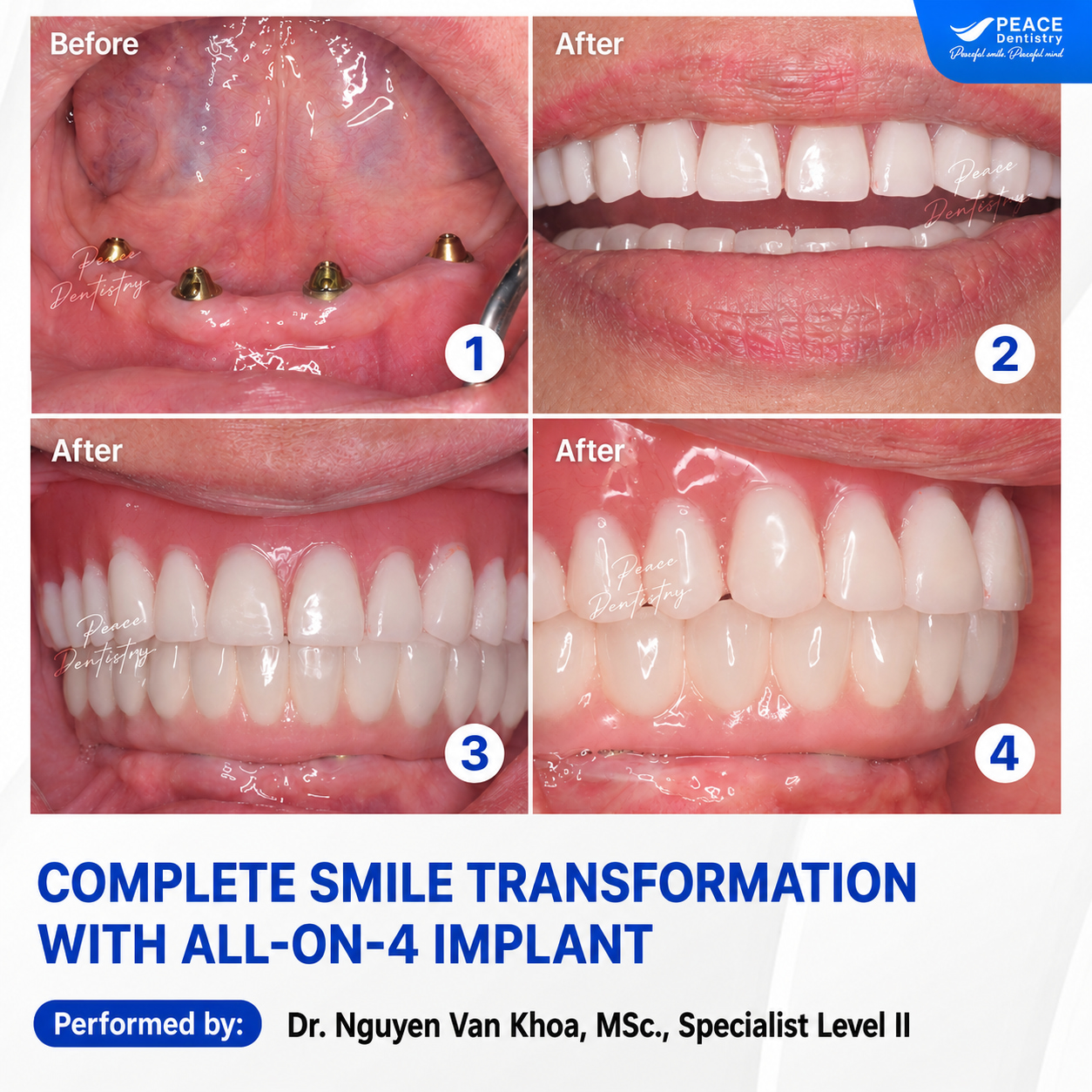 all on 4 implant răng giả như răng thật
