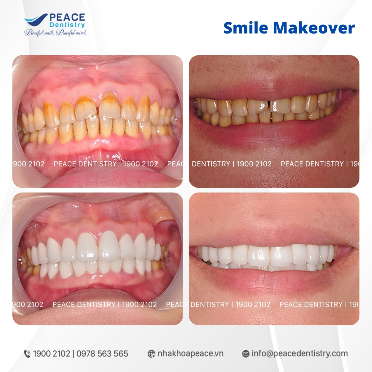 răng sứ zirconia chính hãng