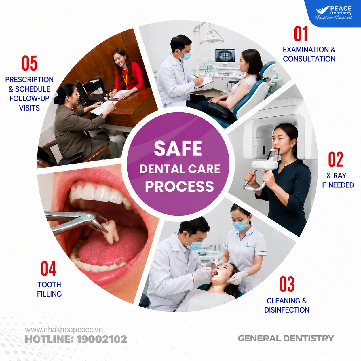 quy trình nhổ răng khôn peace dentistry