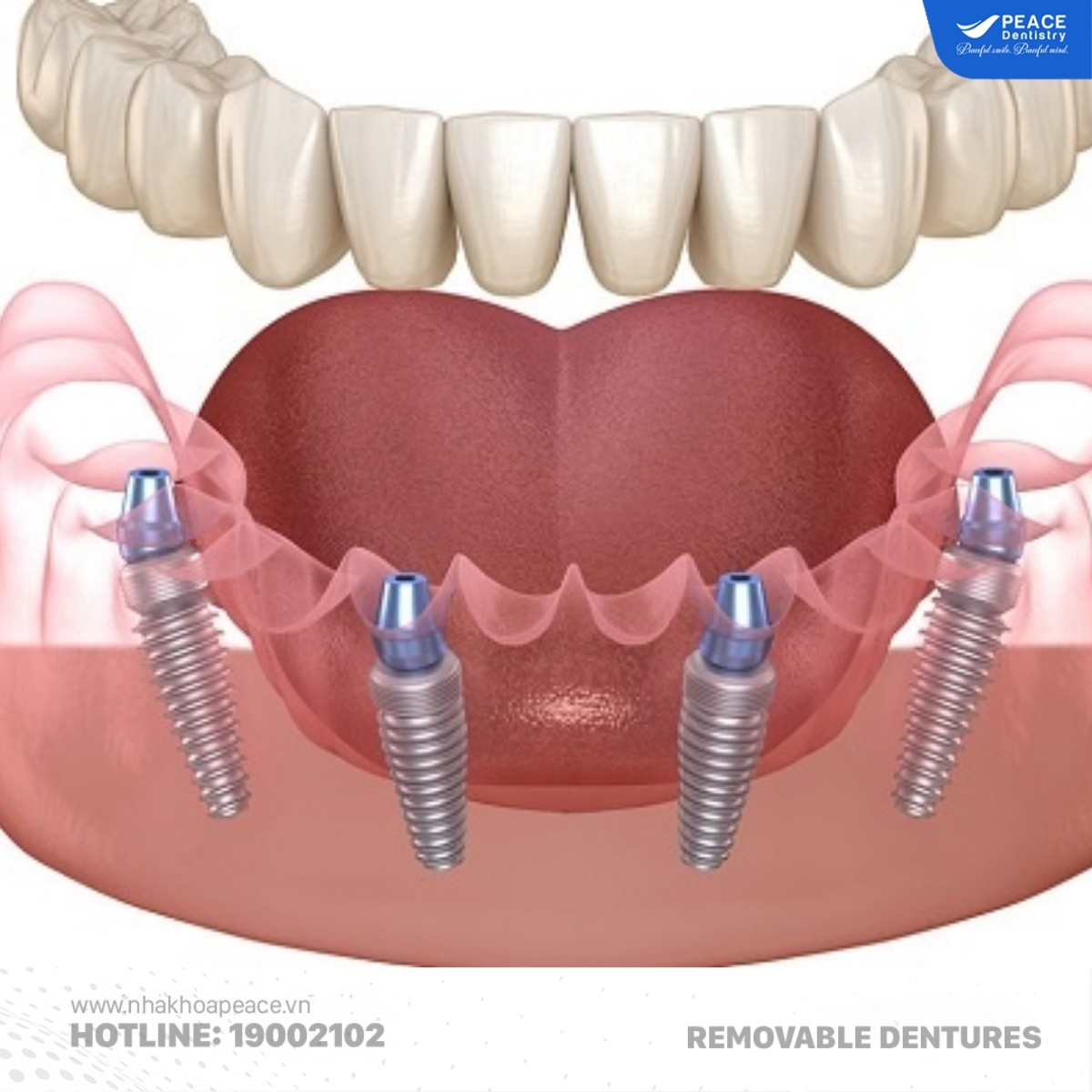 răng giả tháo lắp trên implant