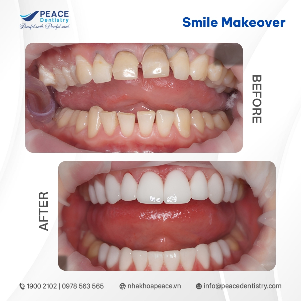 mặt dán sứ veneer mài răng ít