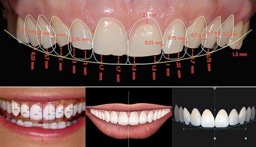 hình ảnh phân tích răng sứ
