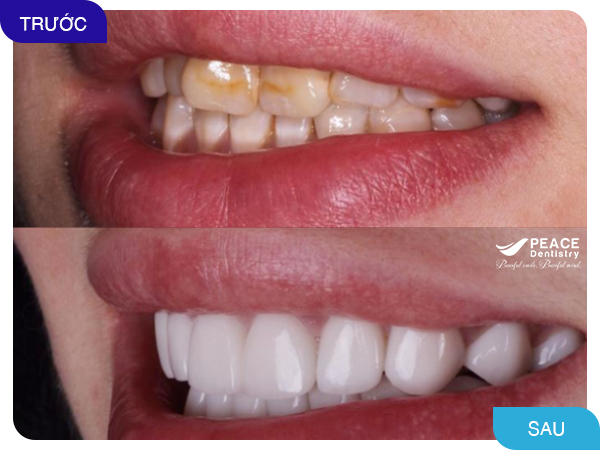 bọc răng sứ cho răng xô lệch