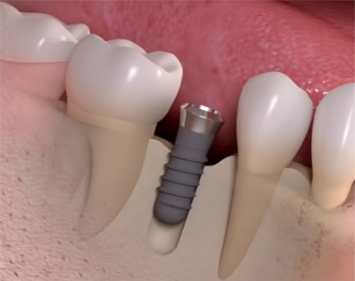 quy trình cấy ghép implant giai đoạn 1