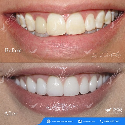 hình ảnh khách hàng bọc răng sứ 31