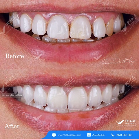 hình ảnh khách hàng bọc răng sứ 32