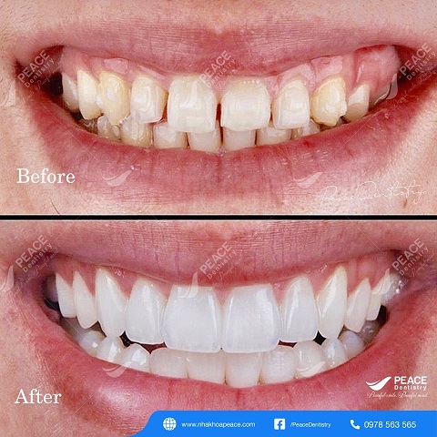 hình ảnh khách hàng bọc răng sứ 34