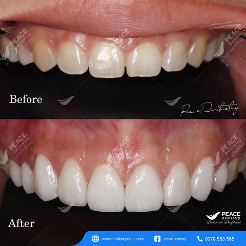 hình ảnh khách hàng dán sứ veneer 1