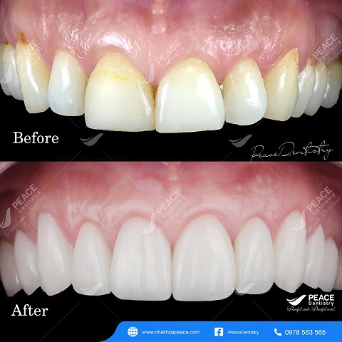 hình ảnh khách hàng dán sứ veneer 2