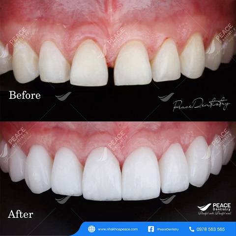 hình ảnh khách hàng dán sứ veneer 3