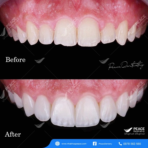 hình ảnh khách hàng dán sứ veneer 4