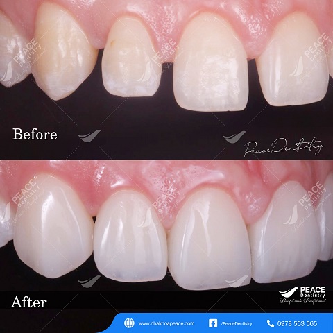 hình ảnh khách hàng dán sứ veneer 5