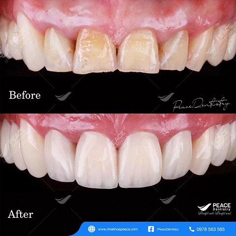 hình ảnh khách hàng dán mặt sứ veneer
